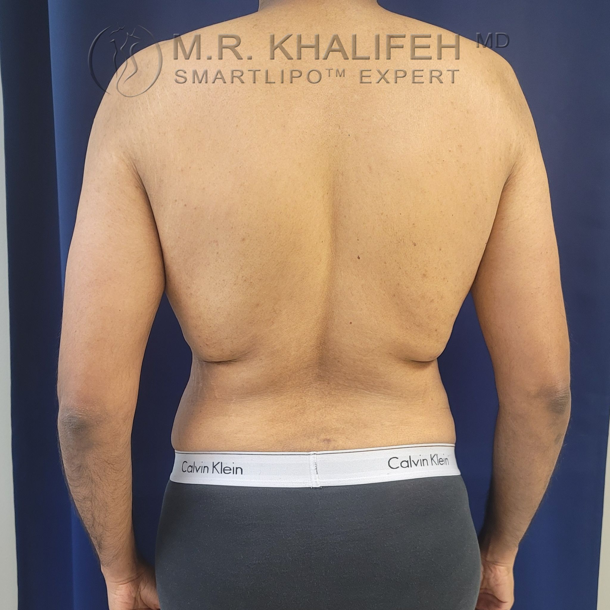 Patient Flank Lower Back Liposuction Male Liposuction Gallery